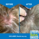 dermasolve-eczema-relief-shampoo---flare-5.jpg